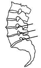 Bel Fıtığı Spinal Kanal