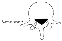 Bel Fıtığı Spinal Kanal