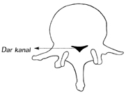 Bel Fıtığı Spinal Kanal