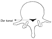 Bel Fıtığı Spinal Kanal