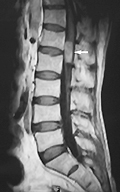 Bel Fıtığı Spinal Tümör
